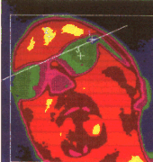 Thermographic picture